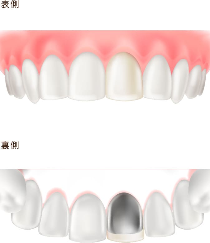 硬質レジン前装冠