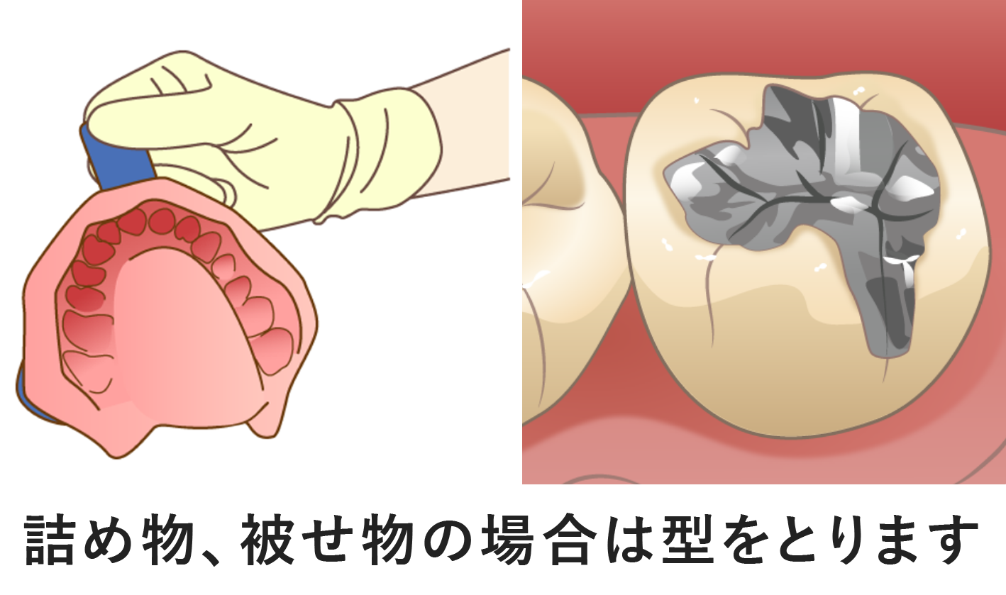 インレー（詰め物）