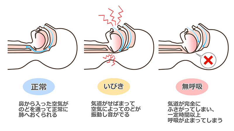睡眠と歯科